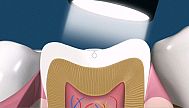 sigillatura dentale